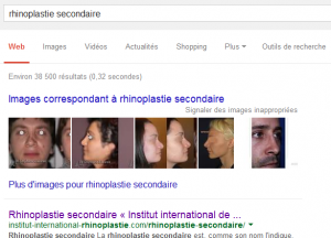 Google Images Rhinoplastie secondaire